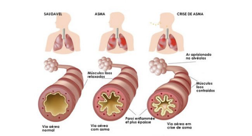 crise de asma